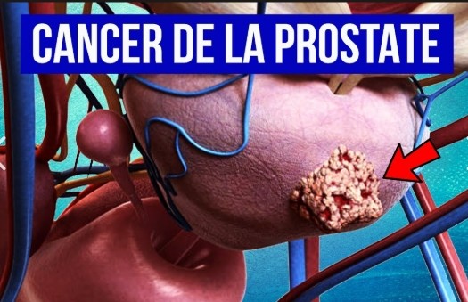 banner Traitement de cancer de la prostate